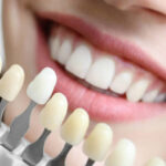 faceta-ou-lente-de-contato-dental-746x413-1